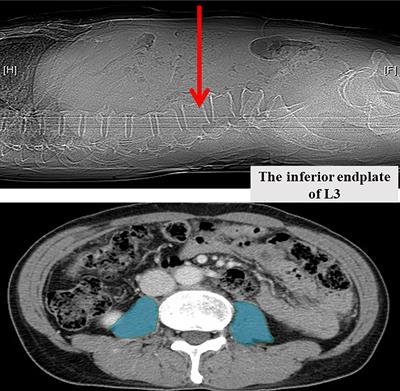 The combination of sarcopenia and biochemical factors can predict the survival of hepatocellular carcinoma patients receiving transarterial chemoembolization